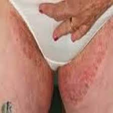 Obat gatal eksim kering di kaki, gatal di selangkangan dan berwarna hitam, obat tradisional hilangkan gatal, penyakit kulit seperti gatal eksim, tips mengatasi eksim, gatal eksim ujung jari, gatal eksim karena alergi, fakta gatal eksim, jenis gatal eksim kering, penyakit eksim gambar, penyakit eksim dan obatnya